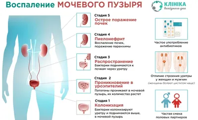 Хроническая анальная трещина - лечение в Москве, запись на прием и  консультацию к проктологу