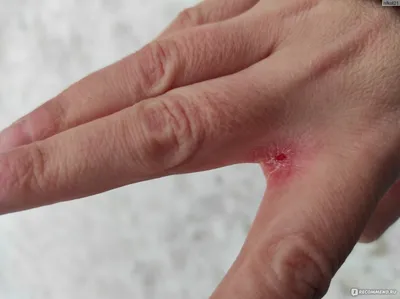Трескается кожа на пальцах рук и ног: почему трескается у взрослых и чем  это лечить