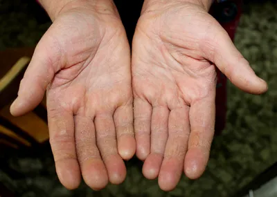 Кожа между пальцами рук шелушится: возможные причины и методы терапии.  Советы по уходу за кожей рук