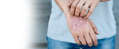 Почему шелушится кожа на руках: причины, лечение и профилактика