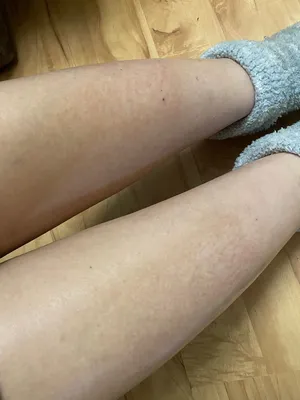 Трескается кожа на ногах — 12 ответов | форум Babyblog