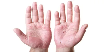 На помощь - кожа рук в ужасном состоянии | Косметиста