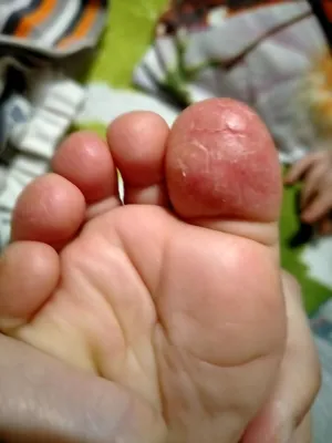 Трескается кожа на пальцах ног у ребёнка - Советчица