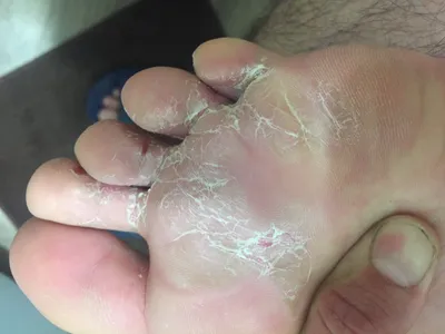 Ответы Mail.ru: Трескается кожа между пальцев на ногах, фото прилагается