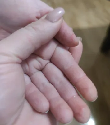 Трескается кожа на пальцах ног у ребенка: возможные причины и методы терапии