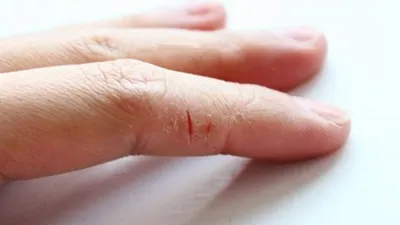Трещины на пальцах рук: как избавиться от проблемы? | Новости Одессы
