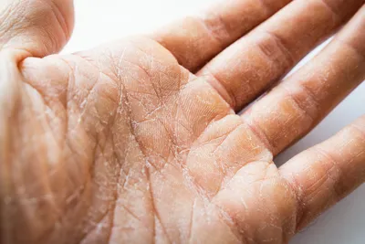 На помощь - кожа рук в ужасном состоянии | Косметиста