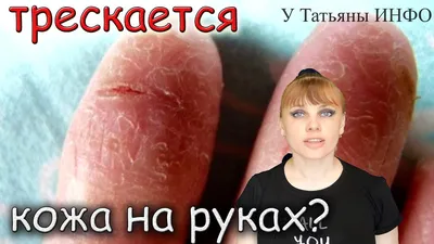 Межпальцевые трещины