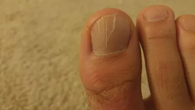 Трескаются ногти на ногах: причины, методы лечения
