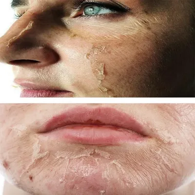 Гибридный ТСА пилинг мягкого действия TCA hybrid safe peeling - купить по  лучшей цене в интернет-магазине корейской косметики Ramosu | Киев, Украина