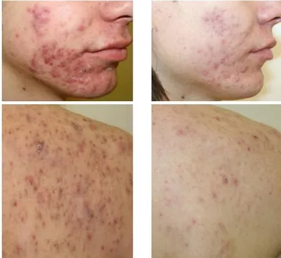 ПИЛИНГ ДЛЯ ЛИЦА ПРХ(PRX-T33) терапия Особенный уход за кожей! состав просто  шедевр: - трихлоруксусная кислота - перекись водорода -… | Instagram