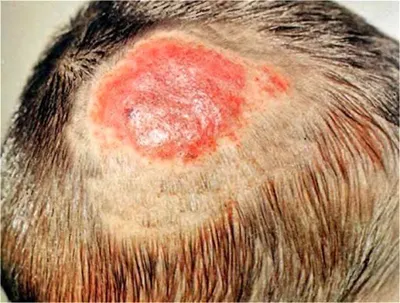 История болезни по дерматовенерологии диагноз: микроспория гладкой кожи |  Схемы Дерматовенерология | Docsity