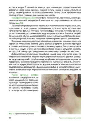 Стригущий лишай – лечение в Киеве | Клиника Бреннера