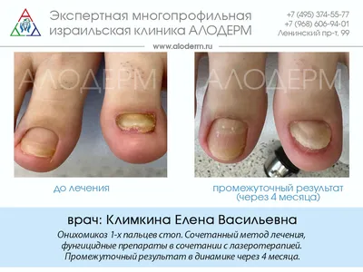 Здорова стопа - Онихомикоз (лат. onychomycosis) — грибковое поражение  ногтя. Вызывается, как правило, грибками-дерматофитами Trichophyton rubrum,  Trichophyton interdigitale, Trichophyton tonsurans, реже Epidermophyton  floccosum и микроспорией ...