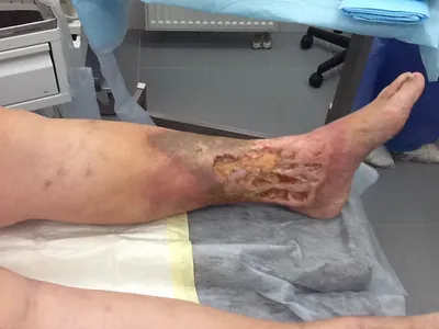 Трофическая язва на ногах в Екатеринбурге, узнать стоимость лечения  трофических язв
