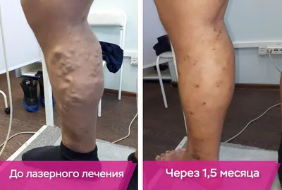 Трофические язвы на ногах: лечение и диагностика в Одессе | Медицинский дом  Odrex