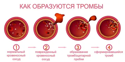 ᐈ 【Тромб в сердце 】 | «Medisense» — клиника в Харькове, лучшие цены