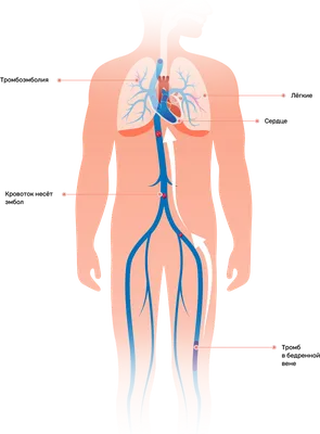 Тромбоэмболия лёгочной артерии - Инновационный сосудистый центр