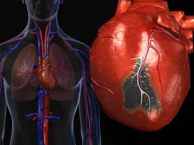 Бактерии десен проникают в кровоток и повышают риск образования тромбов и  сердечного приступа