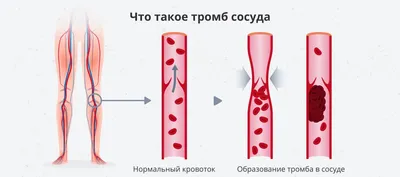 🔓 Как понять, что оторвался тромб и что такое «тихий инфаркт» ❔ |  Энциклопедия Здоровья | Дзен