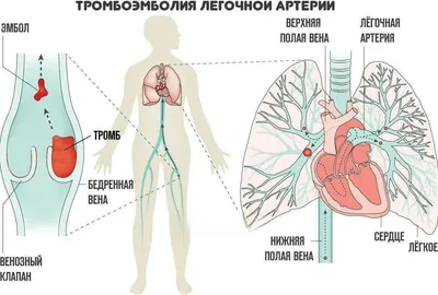 Тромбоз и атеросклероз. Какие признаки поражения артерий?