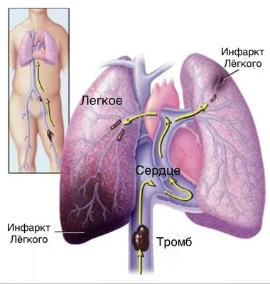 Осторожно тромб — как заметить образование тромба и спасти жизнь, если он  оторвался | Evolutis Clinic | Дзен