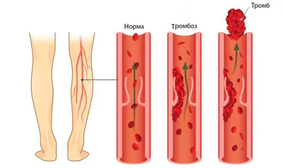 Тромб или тромб блокирующий клетки крови проходили в артерия или  иллюстрации перевода вены 3d. Затромбирование Иллюстрация штока -  иллюстрации насчитывающей биохимии, миокардиально: 207843584