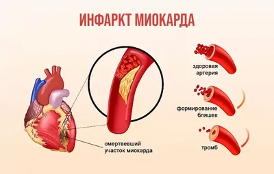 Внутрисердечные тромбы. Диагностика и лечение