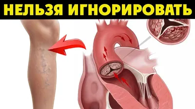 атеросклероз. иллюстрация человеческого сердца. здоровая артерия.  атеросклероз и тромбоз. Иллюстрация вектора - иллюстрации насчитывающей  изолировано, людск: 247762614
