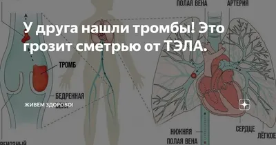 Медицинский Плакат Тромба Сгустка Крови — стоковая векторная графика и  другие изображения на тему Сердце - Сердце, Коронарная артерия, Проблемы -  iStock