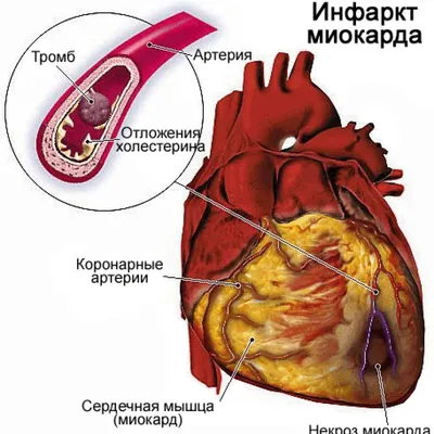 В Кыргызстане из сердца 63-летнего пациента извлекли гигантский тромб весом  435 гр (фото, видео)