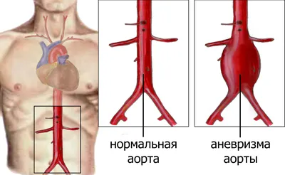 Опухоли сердца. Клинические наблюдения – тема научной статьи по клинической  медицине читайте бесплатно текст научно-исследовательской работы в  электронной библиотеке КиберЛенинка