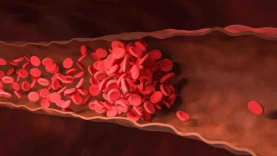 Andrey riabokon - Тромбоэмболия легочной артерии случается чаще в  ответвлении от правого желудочка, или когда делится на основные ветви. Как  это выглядит анатомически?🫁 Внутри сердца это выглядит как змеевидной  формы тромб. Бывает