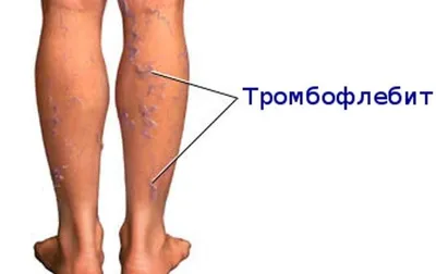 Лечение тромбоза и тромбофлебита нижних конечностей - «Институт Вен»  лечение варикоза в Киеве и Харькове