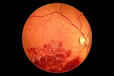Тромбозы вен сетчатки глаза - Лечение в Волгограде в МНТК