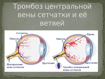 Тромбоз сетчатки глаза фото фото