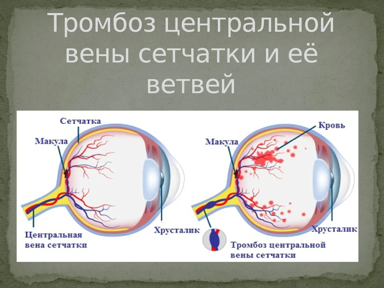 Тромбозы центральных вен. Центральная Вена сетчатки. Окклюзия центральной вены сетчатки. Тромбоз ветвей сетчатки. Претромбоз центральной вены сетчатки.