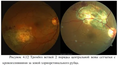 Сосудистые заболевания сетчатки (макулярный отек, тромбоз, поражение  сосудов и др.)