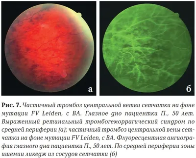 Тромбоз центральной вены... - Глазная клиника Saif-Optima | Facebook