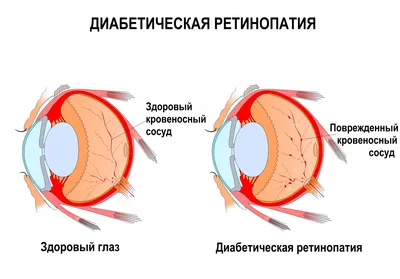 Какие бывают болезни сетчатки глаза - Офтальмологические клиники «Эксимер»  (Одесса) - диагностика и лечение заболеваний глаз у взрослых и детей