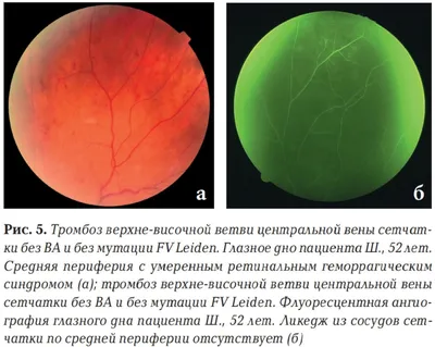 Рис. 5. Тромбоз верхне-височной ветви центральной вены сетчатки без ВА…