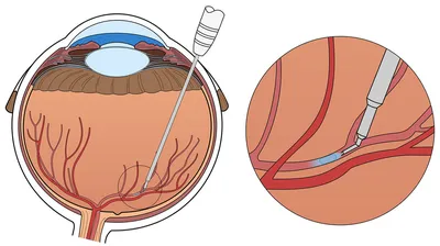 Тромбоз вен сетчатки глаза | VISTA | Дзен