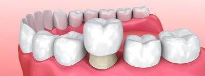 Штампованная коронка: плюсы и минусы, препарирование