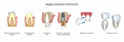 Цельнолитые коронки на зубы -- преимущества и недостатки