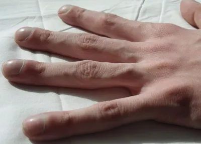 О каких заболеваниях говорят ногти на руках и ногах - Лайфхакер
