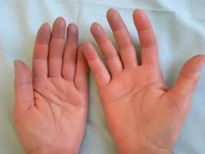 Почему у меня синеют кончики пальцев: насколько это опасно и при каких  болезнях бывает? | О здоровье: с медицинского на русский | Дзен