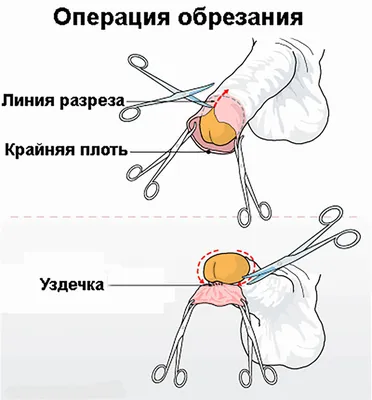 Циркумцизия : цена обрезания крайней плоти в Одессе
