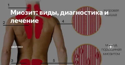 Figure: Жизненный цикл свиного цепня - Справочник MSD Версия для  потребителей