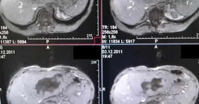 Больной Ребенок С Красными Пятнами Сыпи От Кори — стоковые фотографии и  другие картинки Цистицеркоз - Цистицеркоз, Ребёнок, Инфекционная болезнь -  iStock