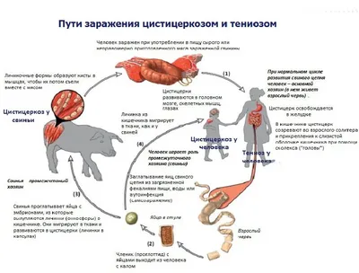 Цистицеркоз и тениоз у взрослых: поражение мозга гельминтами» — Яндекс Кью